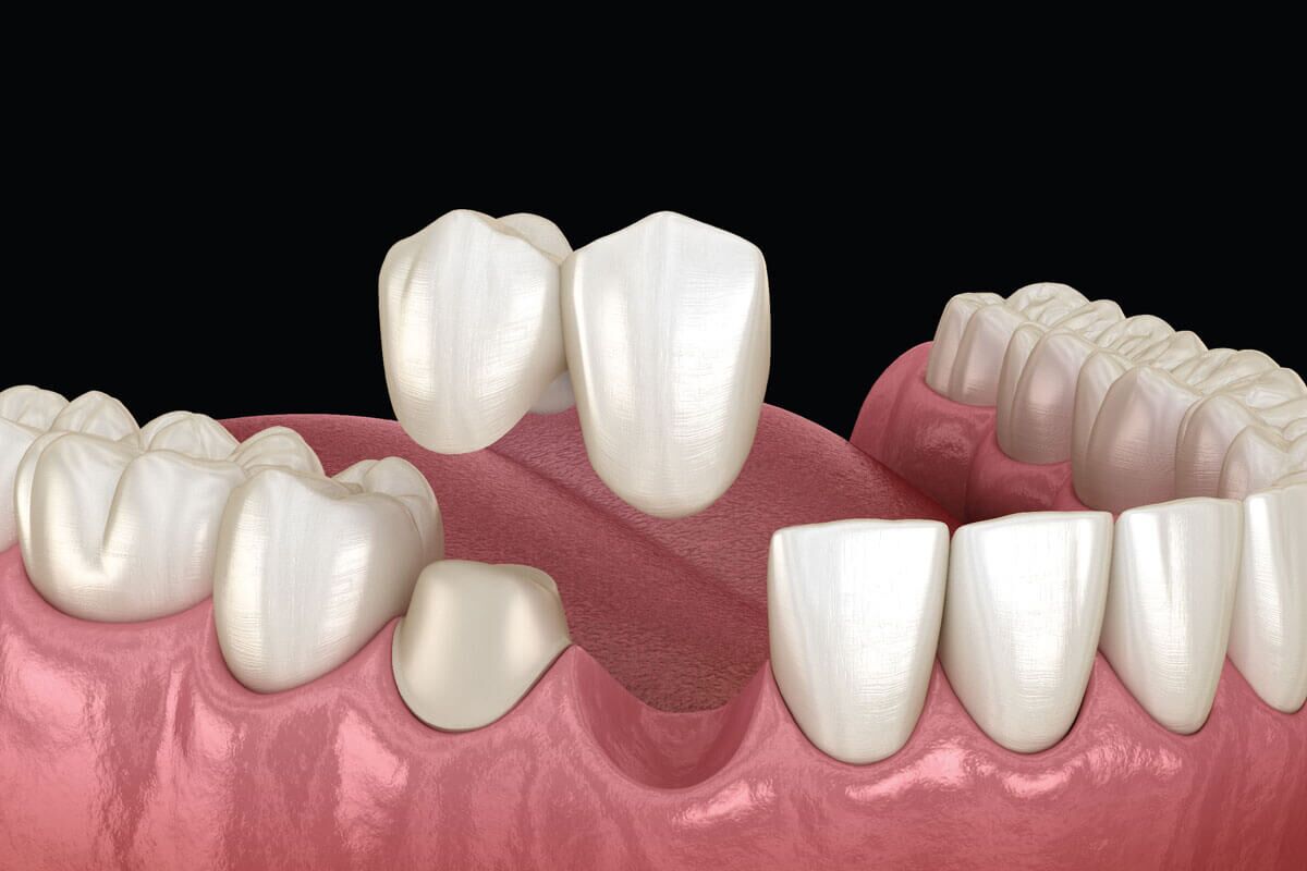 Dental Bridges in Dubai - Restore Your Smile - Dr Michaels