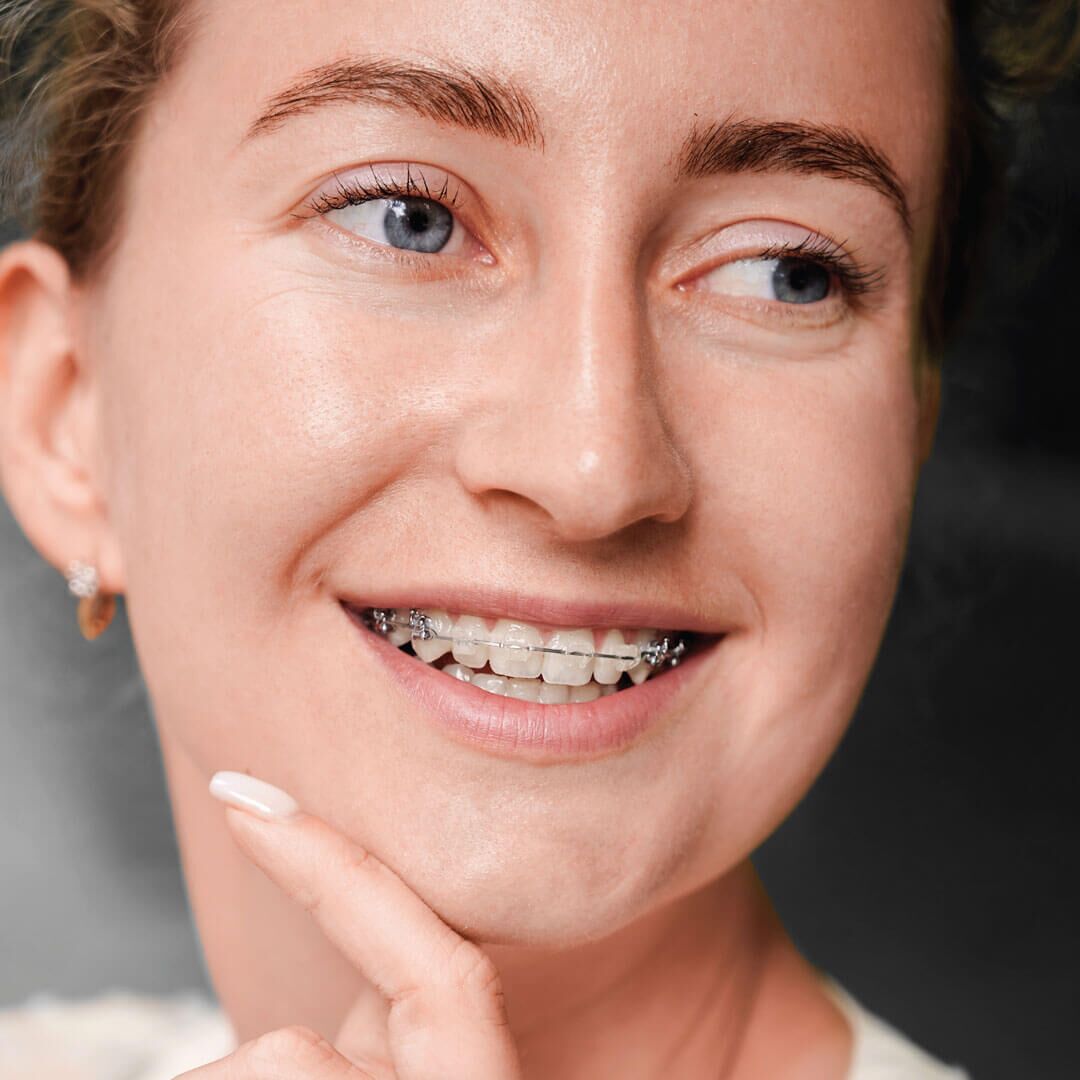 Ceramic Braces in Dubai - Clear Fixed Ceramic Braces in Dubai