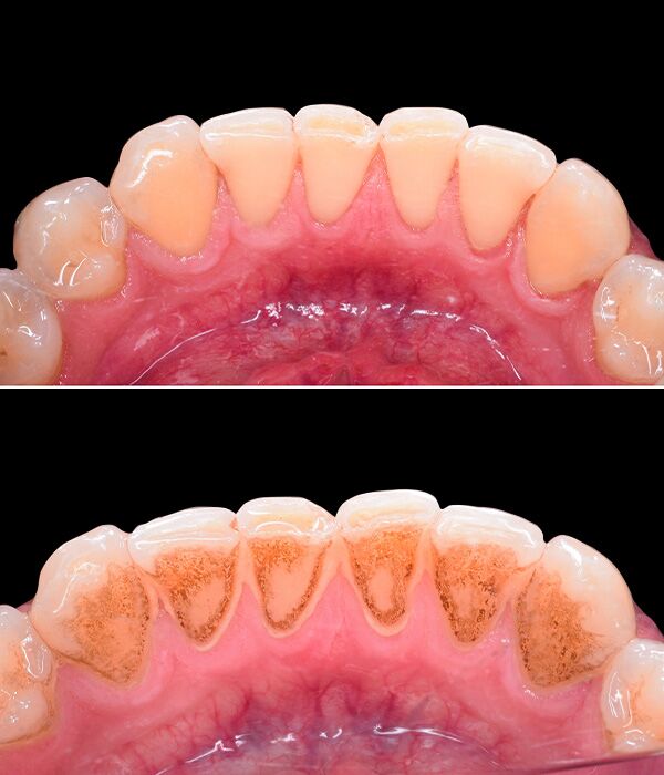 Teeth Cleaning in Dubai - Dental Scaling and Polishing