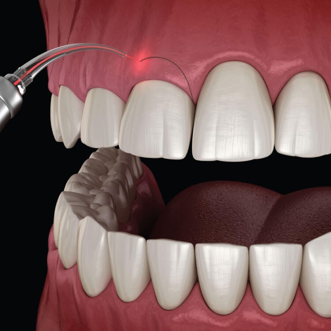 Gummy Smile (Laser Gum Contouring / Botox) - Gentle Smile Dental Studio