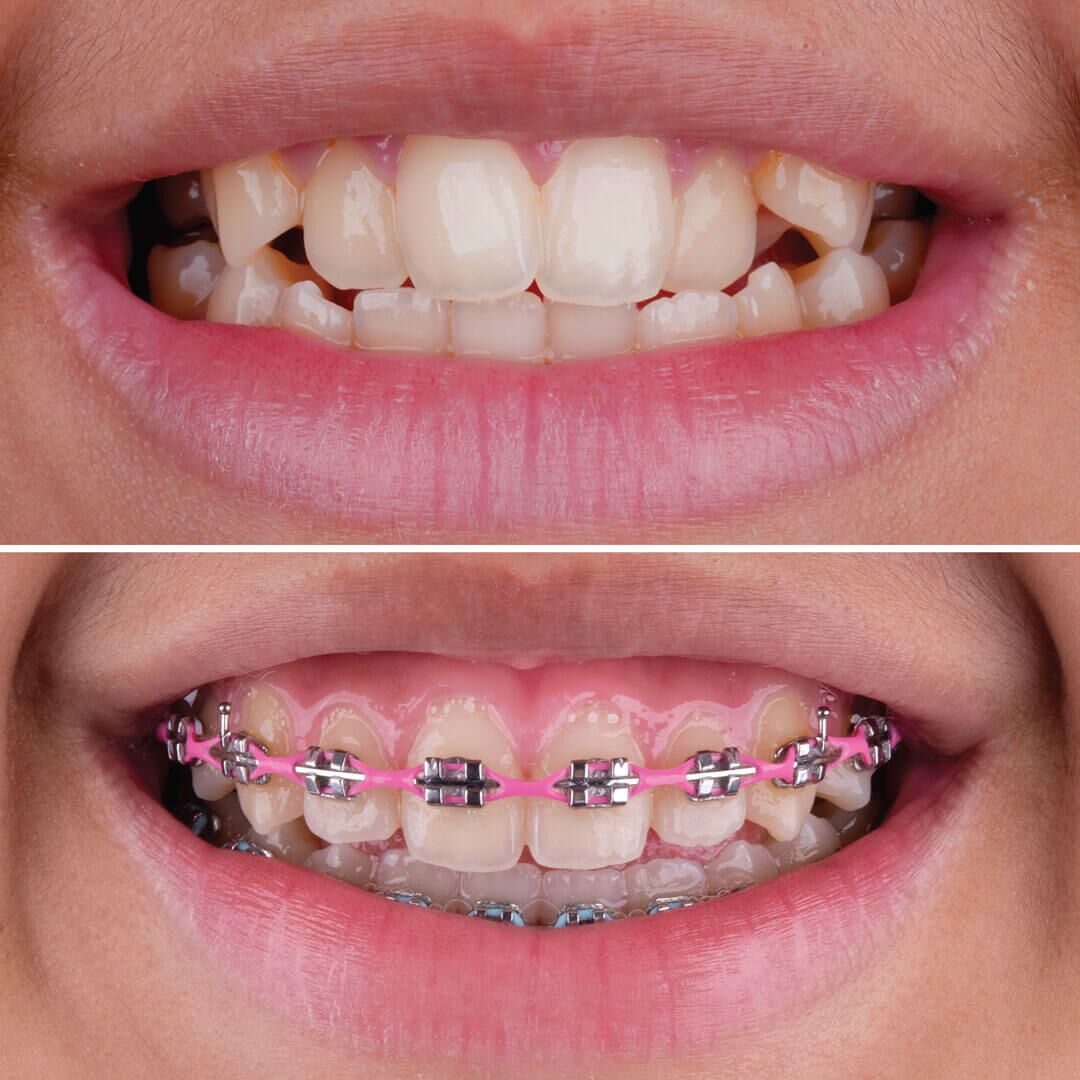 How Braces Work- Elements of the orthodontic treatment and its role © 
