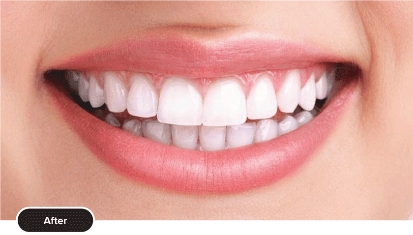 Zoom Teeth Whitening in Dubai - Dr Michales Dental Clinic